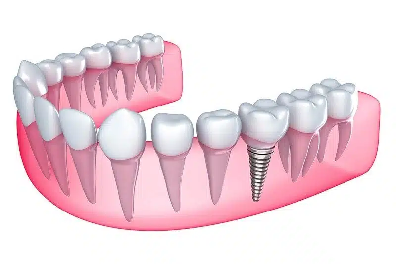 Địa Chỉ Trồng Răng Implant Uy Tín Hà Nội