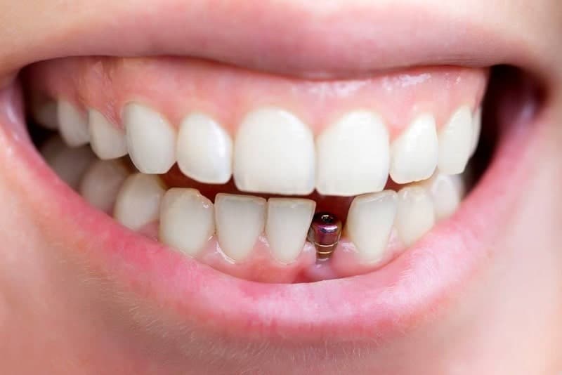 Địa Chỉ Trồng Răng Implant Uy Tín Hà Nội